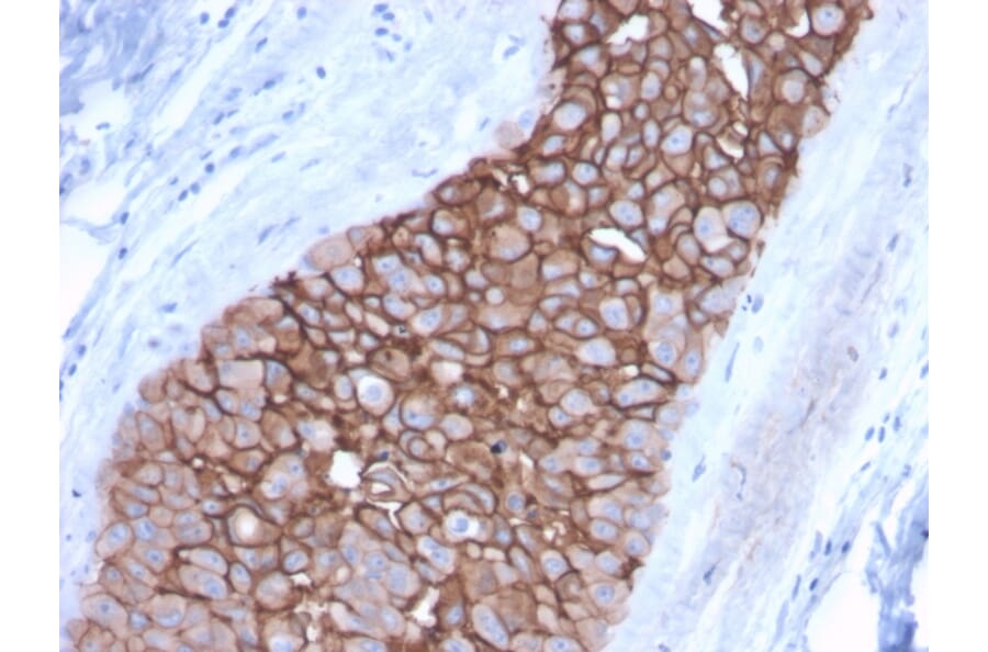 Immunohistochemistry (formalin-fixed, paraffin-embedded) - Anti-ErbB2 Antibody [ERBB2/3092] (CF®488A) (A354228) - Antibodies.com