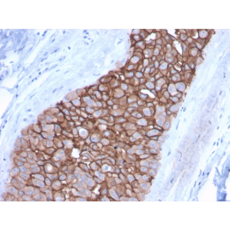 Immunohistochemistry (formalin-fixed, paraffin-embedded) - Anti-ErbB2 Antibody [ERBB2/3092] (CF®488A) (A354228) - Antibodies.com