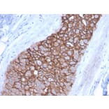 Immunohistochemistry (formalin-fixed, paraffin-embedded) - Anti-ErbB2 Antibody [ERBB2/3092] (CF®488A) (A354228) - Antibodies.com