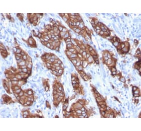 Immunohistochemistry (formalin-fixed, paraffin-embedded) - Anti-ErbB2 Antibody [ERBB2/3093] (CF®405S) (A354231) - Antibodies.com