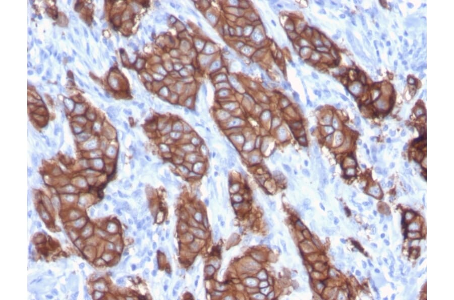Immunohistochemistry (formalin-fixed, paraffin-embedded) - Anti-ErbB2 Antibody [ERBB2/3093] (CF®405S) (A354231) - Antibodies.com