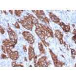 Immunohistochemistry (formalin-fixed, paraffin-embedded) - Anti-ErbB2 Antibody [ERBB2/3093] (CF®405S) (A354231) - Antibodies.com