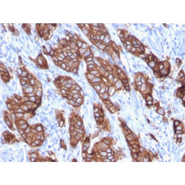 Immunohistochemistry (formalin-fixed, paraffin-embedded) - Anti-ErbB2 Antibody [ERBB2/3093] (CF®740) (A354235) - Antibodies.com