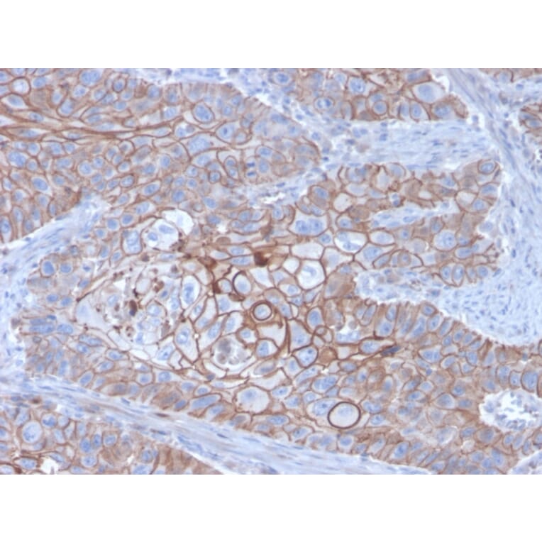 Immunohistochemistry (formalin-fixed, paraffin-embedded) - Anti-E-Cadherin Antibody [CDH1/3256] (CF®405S) (A354272) - Antibodies.com
