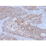 Immunohistochemistry (formalin-fixed, paraffin-embedded) - Anti-E-Cadherin Antibody [CDH1/3256] (CF®640R) (A354273) - Antibodies.com