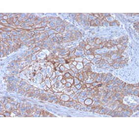 Immunohistochemistry (formalin-fixed, paraffin-embedded) - Anti-E-Cadherin Antibody [CDH1/3256] (CF®647) (A354274) - Antibodies.com