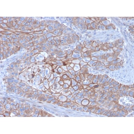Immunohistochemistry (formalin-fixed, paraffin-embedded) - Anti-E-Cadherin Antibody [CDH1/3256] (CF®740) (A354276) - Antibodies.com
