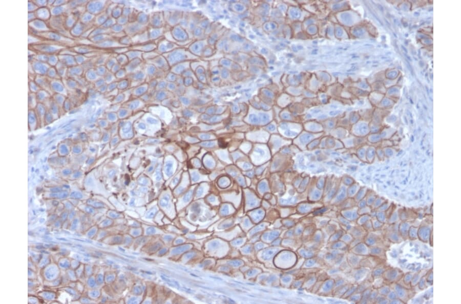 Immunohistochemistry (formalin-fixed, paraffin-embedded) - Anti-E-Cadherin Antibody [CDH1/3256] (CF®488A) (A354277) - Antibodies.com