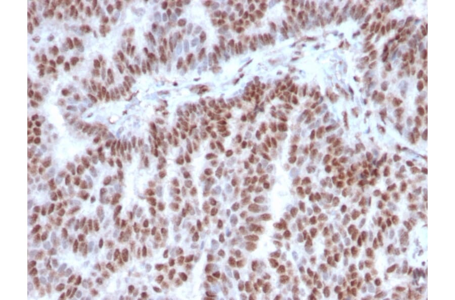 Immunohistochemistry (formalin-fixed, paraffin-embedded) - Anti-Estrogen Receptor alpha Antibody [ESR1/3342] (CF®740) (A354324) - Antibodies.com