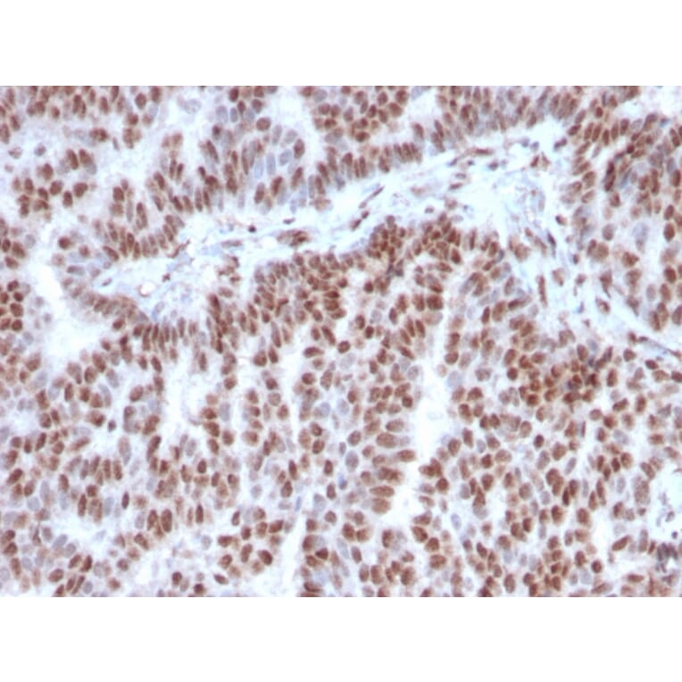 Immunohistochemistry (formalin-fixed, paraffin-embedded) - Anti-Estrogen Receptor alpha Antibody [ESR1/3342] (CF®740) (A354324) - Antibodies.com