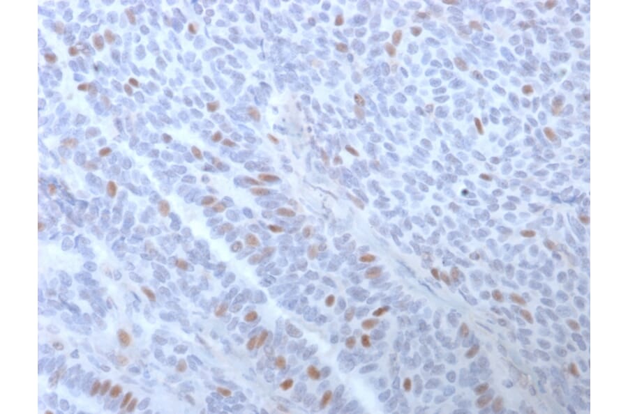 Immunohistochemistry (formalin-fixed, paraffin-embedded) - Anti-Estrogen Receptor alpha Antibody [ESR1/3373] (CF®568) (A354331) - Antibodies.com