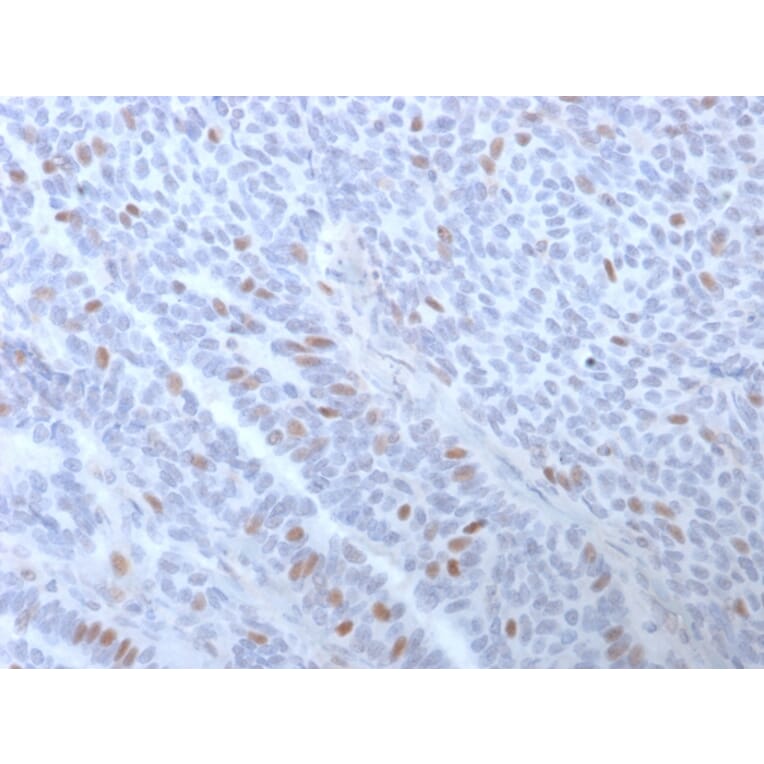 Immunohistochemistry (formalin-fixed, paraffin-embedded) - Anti-Estrogen Receptor alpha Antibody [ESR1/3373] (CF®568) (A354331) - Antibodies.com