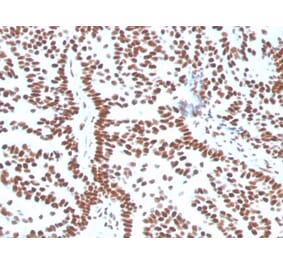 Immunohistochemistry (formalin-fixed, paraffin-embedded) - Anti-Estrogen Receptor alpha Antibody [ESR1/3556] (CF®405S) (A354384) - Antibodies.com