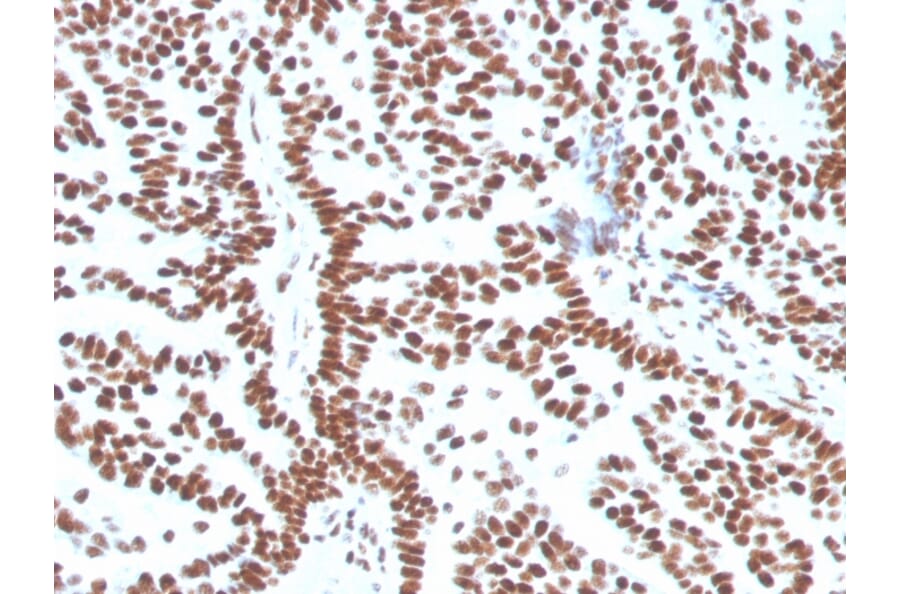 Immunohistochemistry (formalin-fixed, paraffin-embedded) - Anti-Estrogen Receptor alpha Antibody [ESR1/3556] (CF®640R) (A354385) - Antibodies.com