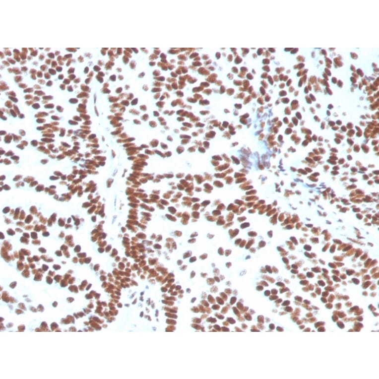 Immunohistochemistry (formalin-fixed, paraffin-embedded) - Anti-Estrogen Receptor alpha Antibody [ESR1/3556] (CF®568) (A354387) - Antibodies.com