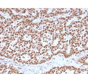 Immunohistochemistry (formalin-fixed, paraffin-embedded) - Anti-Estrogen Receptor alpha Antibody [ESR1/3557] (CF®640R) (A354393) - Antibodies.com