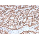 Immunohistochemistry (formalin-fixed, paraffin-embedded) - Anti-Estrogen Receptor alpha Antibody [ESR1/3557] (CF®740) (A354396) - Antibodies.com