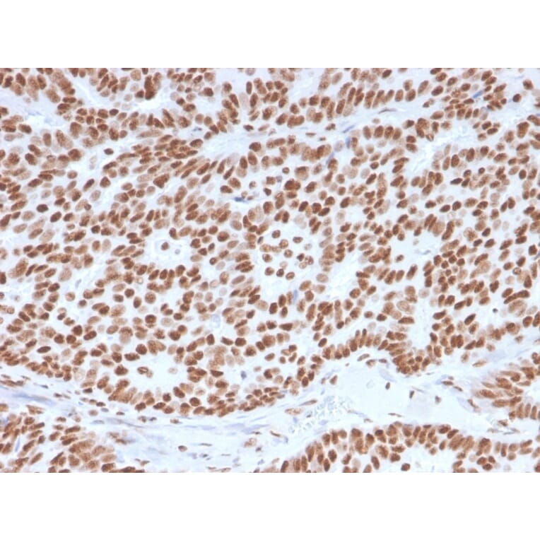 Immunohistochemistry (formalin-fixed, paraffin-embedded) - Anti-Estrogen Receptor alpha Antibody [ESR1/3557] (CF®594) (A354398) - Antibodies.com