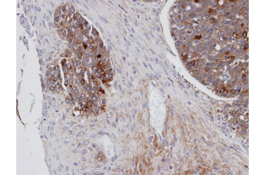 Immunohistochemistry - Mesothelin antibody from Signalway Antibody (22884) - Antibodies.com