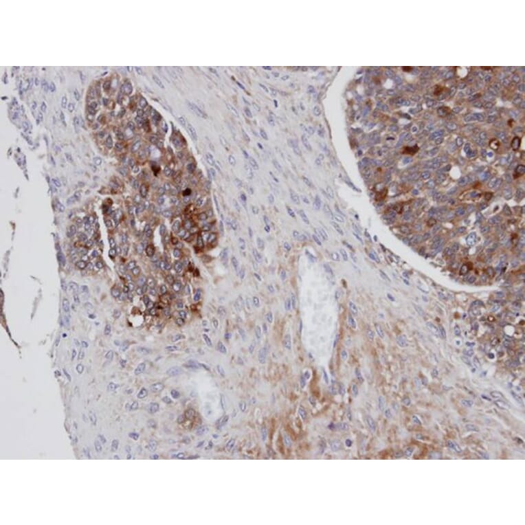 Immunohistochemistry - Mesothelin antibody from Signalway Antibody (22884) - Antibodies.com