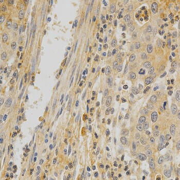 Immunohistochemistry of paraffin-embedded human stomach cancer using TNFRSF11B antibody at dilution of 1: 200 (x400 lens)