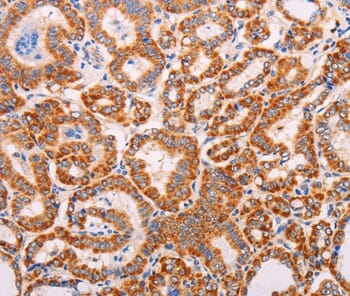 Immunohistochemical analysis of paraffin-embedded Human thyroid cancer tissue using #37315 at dilution 1/60.