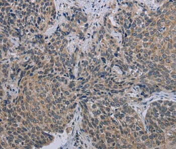 Immunohistochemical analysis of paraffin-embedded Human cervical cancer tissue using #37717 at dilution 1/40.
