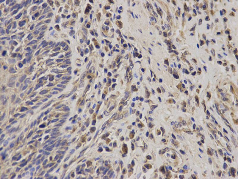 Immunohistochemical analysis of paraffin-embedded human oesophageal cancer using TACSTD1 antibody at dilution of 1: 100 (400x lens).