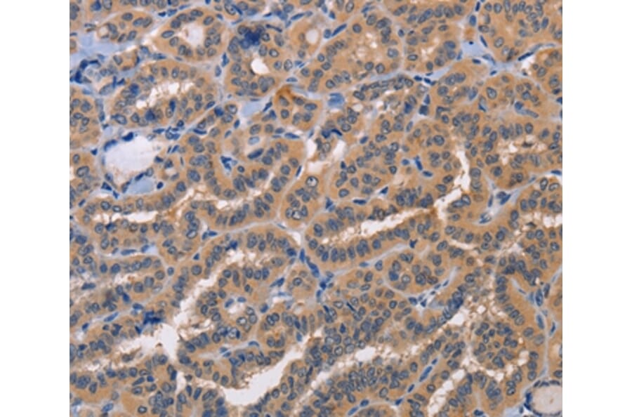 Immunohistochemistry - AKR1B10 Antibody from Signalway Antibody (36071) - Antibodies.com