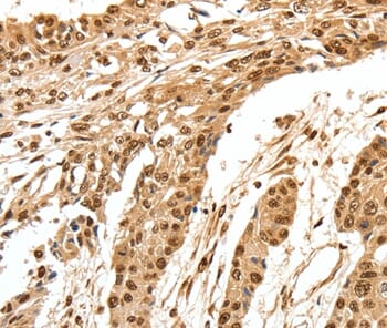 Immunohistochemical analysis of paraffin-embedded Human oesophagus cancer tissue using #37253 at dilution 1/70.