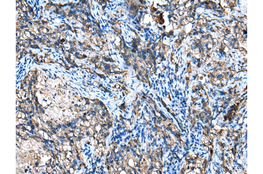 Immunohistochemistry - IGF2BP3 Antibody from Signalway Antibody (42708) - Antibodies.com