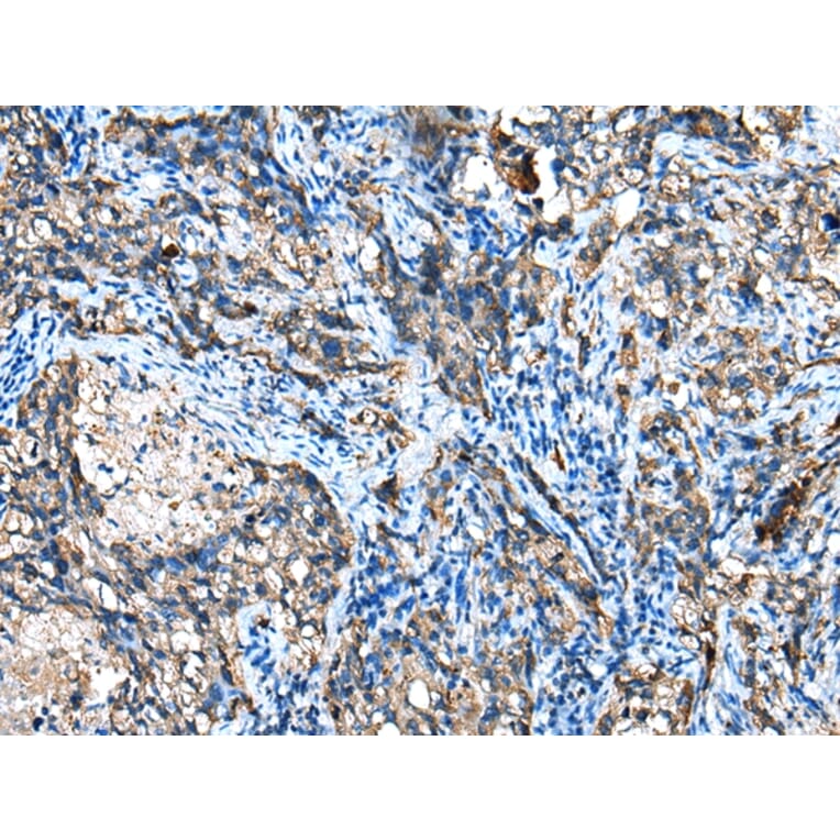 Immunohistochemistry - IGF2BP3 Antibody from Signalway Antibody (42708) - Antibodies.com