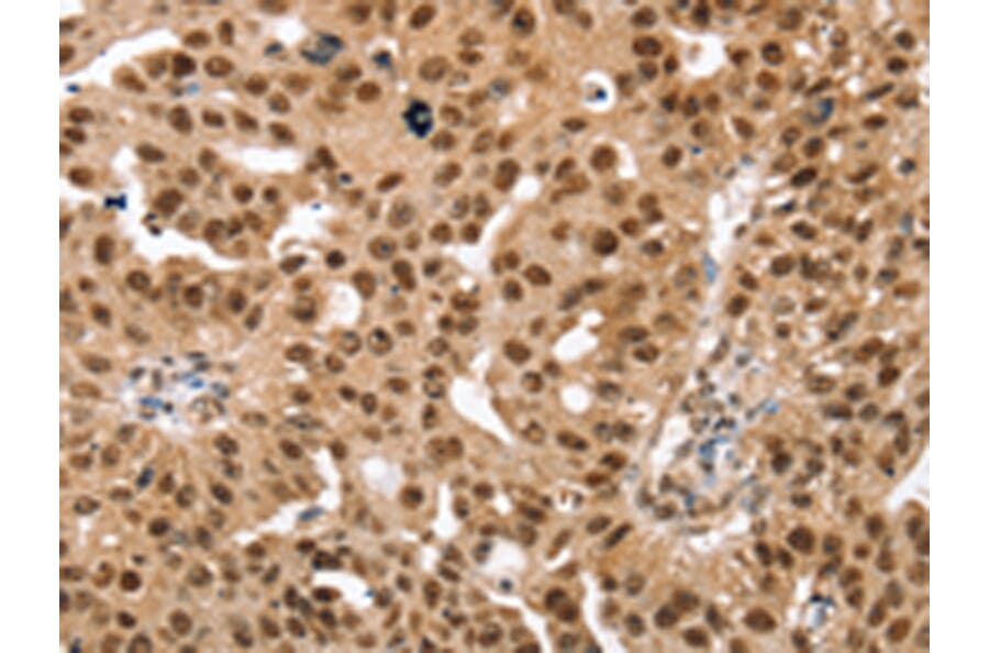 Immunohistochemistry - SMARCB1 Antibody from Signalway Antibody (42763) - Antibodies.com