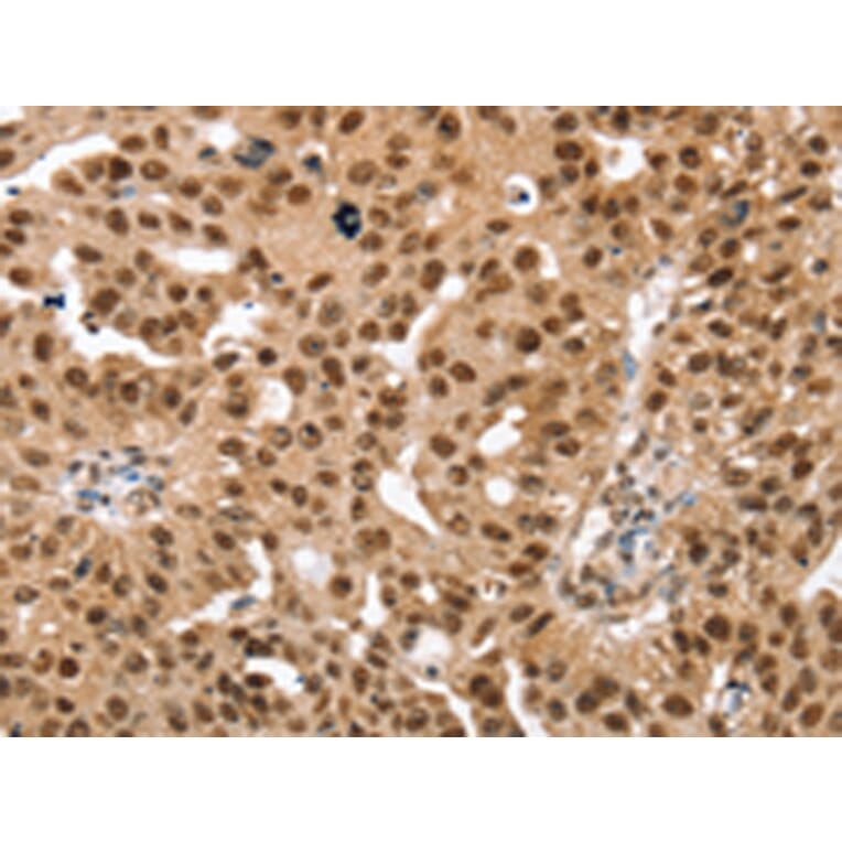 Immunohistochemistry - SMARCB1 Antibody from Signalway Antibody (42763) - Antibodies.com