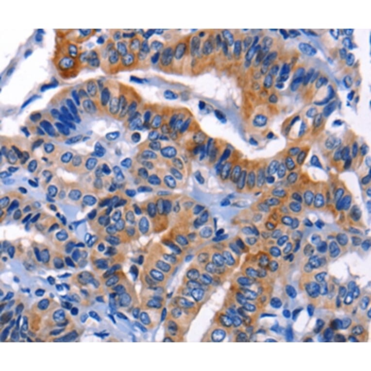 Immunohistochemistry - CHI3L1 Antibody from Signalway Antibody (35680) - Antibodies.com
