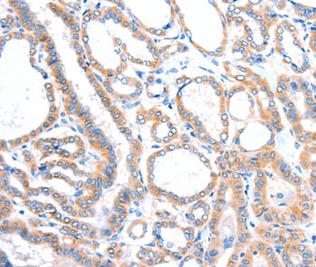 Immunohistochemical analysis of paraffin-embedded Human thyroid cancer tissue using #35999 at dilution 1/20.