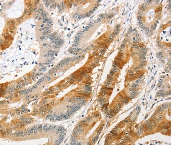 Immunohistochemical analysis of paraffin-embedded Human colon cancer tissue using #36111 at dilution 1/20.