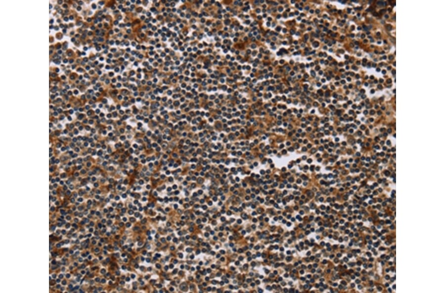 Immunohistochemistry - MAGEA3 Antibody from Signalway Antibody (37138) - Antibodies.com
