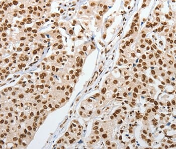 Immunohistochemical analysis of paraffin-embedded Human lung cancer tissue using #37360 at dilution 1/20.