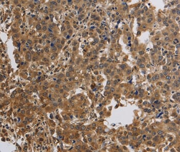 Immunohistochemical analysis of paraffin-embedded Human liver cancer tissue using #37680 at dilution 1/40.