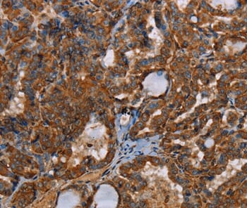 Immunohistochemical analysis of paraffin-embedded Human thyroid cancer tissue using #37841 at dilution 1/30.