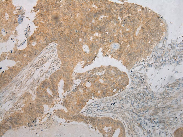 Immunohistochemical analysis of paraffin-embedded Human Colorectal cancer tissue using #40251 at dilution 1/100.