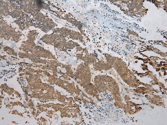 Immunohistochemical analysis of paraffin-embedded Human Lung cancer tissue using #40251 at dilution 1/100.