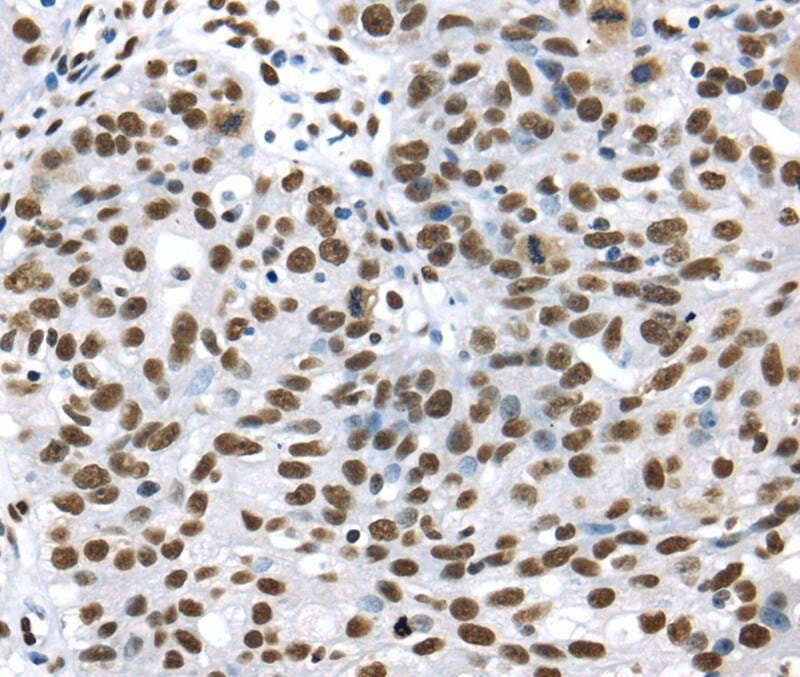 Immunohistochemical analysis of paraffin-embedded Human breast cancer tissue using #40275 at dilution 1/35.