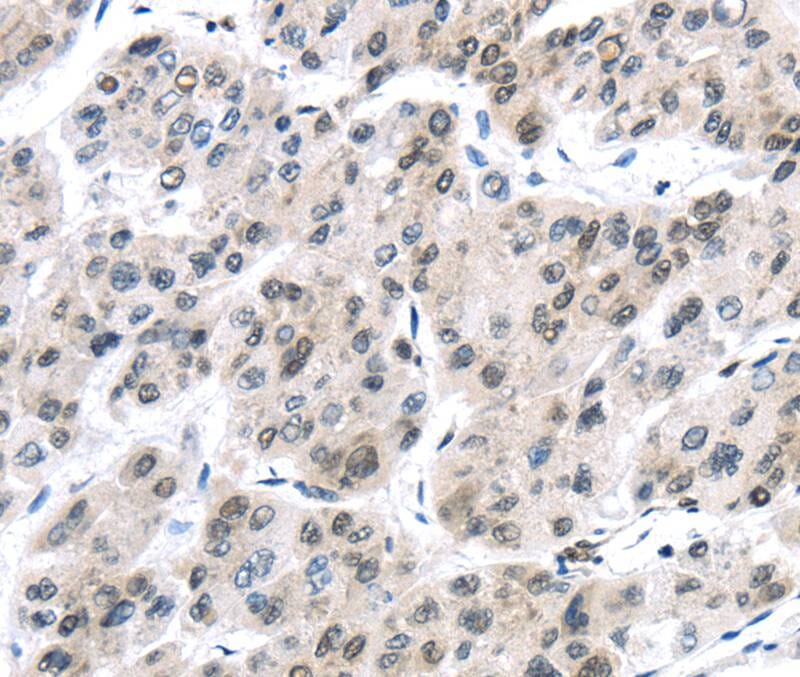 Immunohistochemical analysis of paraffin-embedded Human liver cancer tissue using #40275 at dilution 1/35.