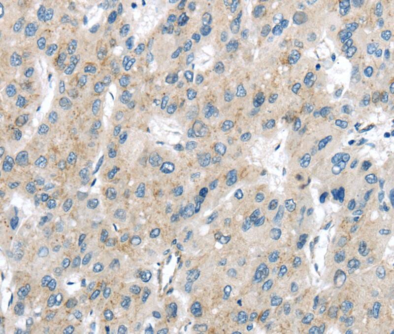 Immunohistochemical analysis of paraffin-embedded Human liver cancer tissue using #40295 at dilution 1/40.