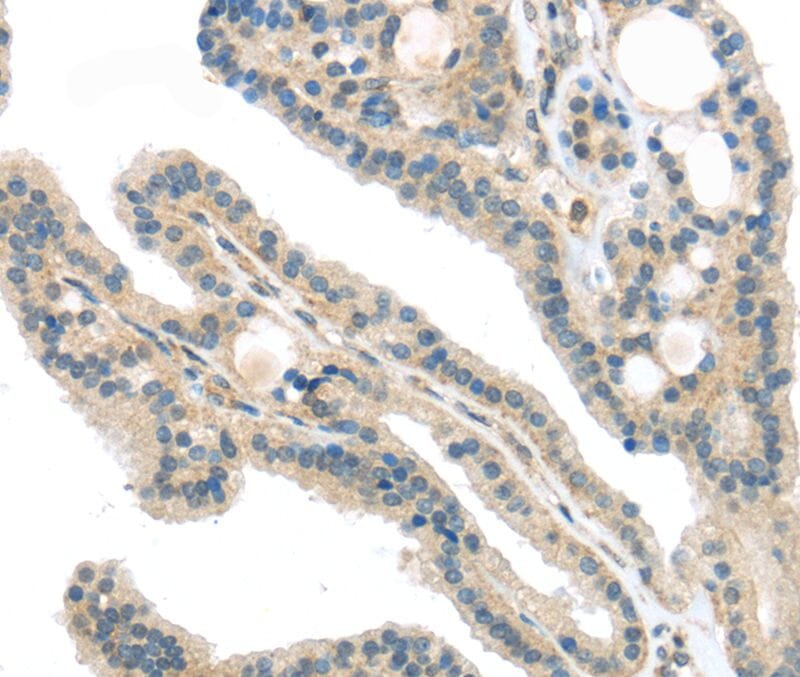 Immunohistochemical analysis of paraffin-embedded Human thyroid cancer tissue using #40295 at dilution 1/40.