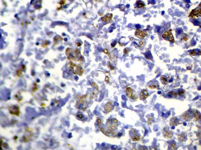 Immunohistochemical analysis of paraffin-embedded Human Liver cancer tissue using #40316 at dilution 1/100.