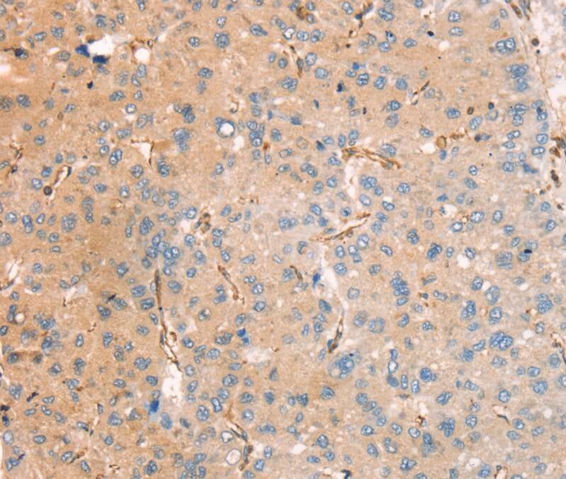 Immunohistochemical analysis of paraffin-embedded Human liver cancer tissue using #40317 at dilution 1/40.