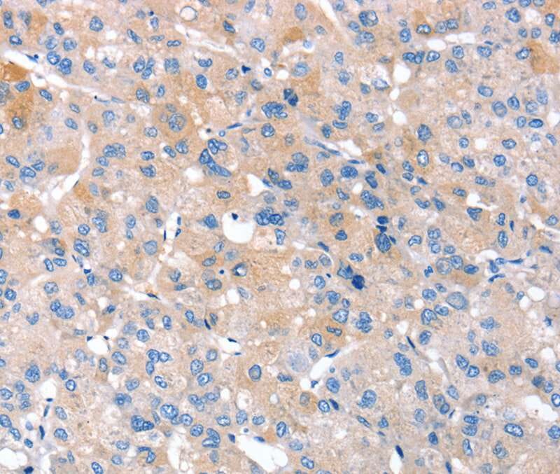 Immunohistochemical analysis of paraffin-embedded Human liver cancer tissue using #40325 at dilution 1/20.